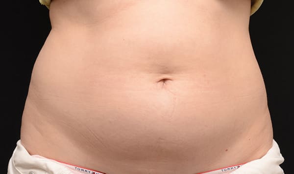 Before Coolsculpting at Expressions MD